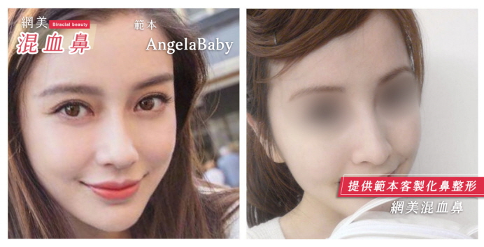 台北隆鼻手術權威醫師隆鼻範本,Angelababy楊穎鼻型,混血高挺鼻型