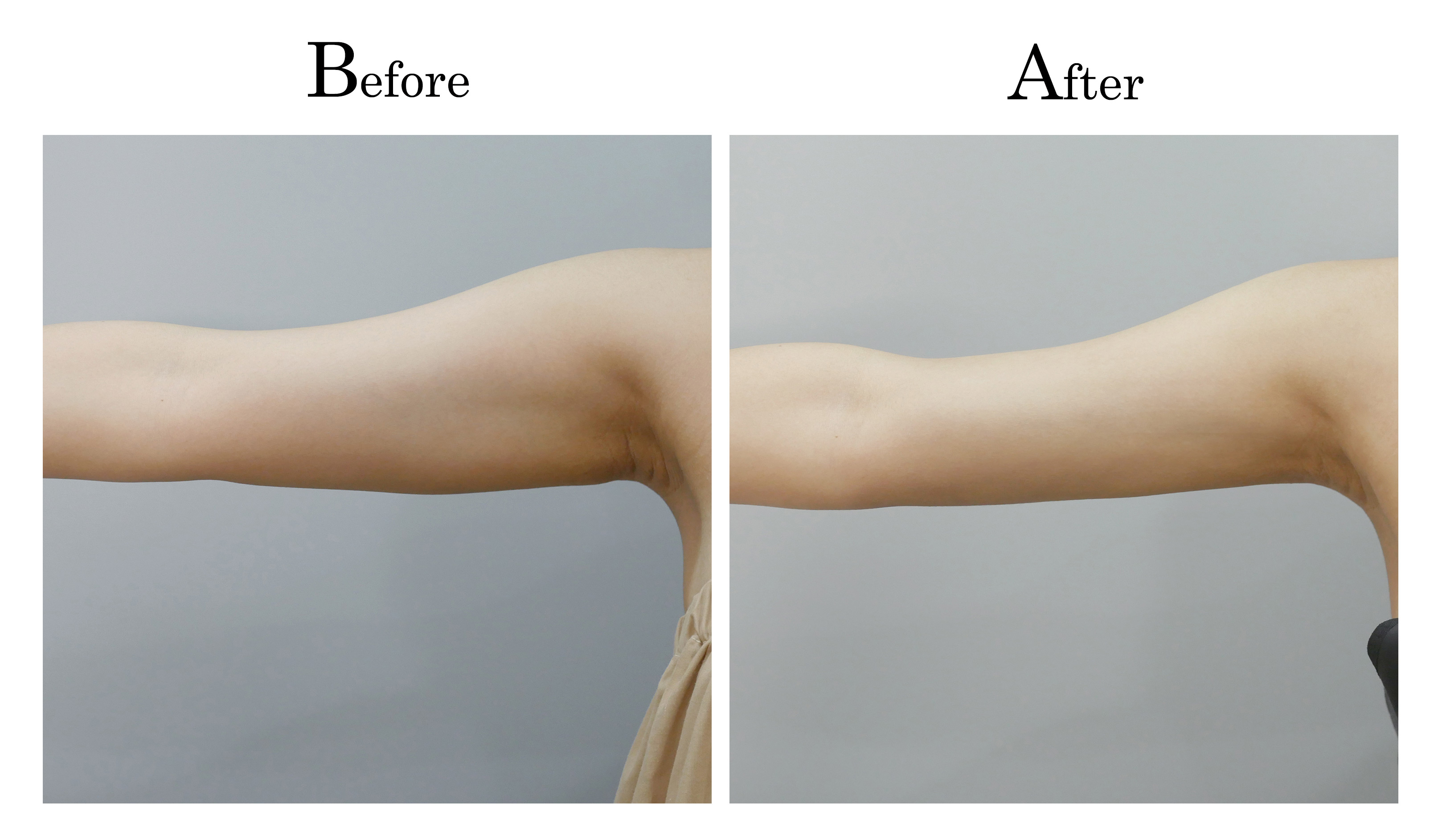 案例分享：副乳+手臂吸脂+黄金微雕术后2个月 - 知乎