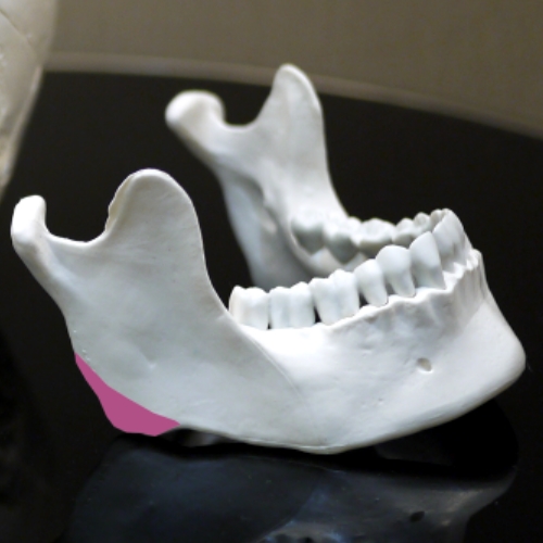 3D削骨手術 - 3D列印應用在削骨手術