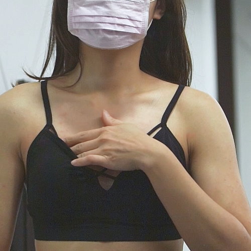 【預告】胸廓不大客製化隆乳手術美胸再造
