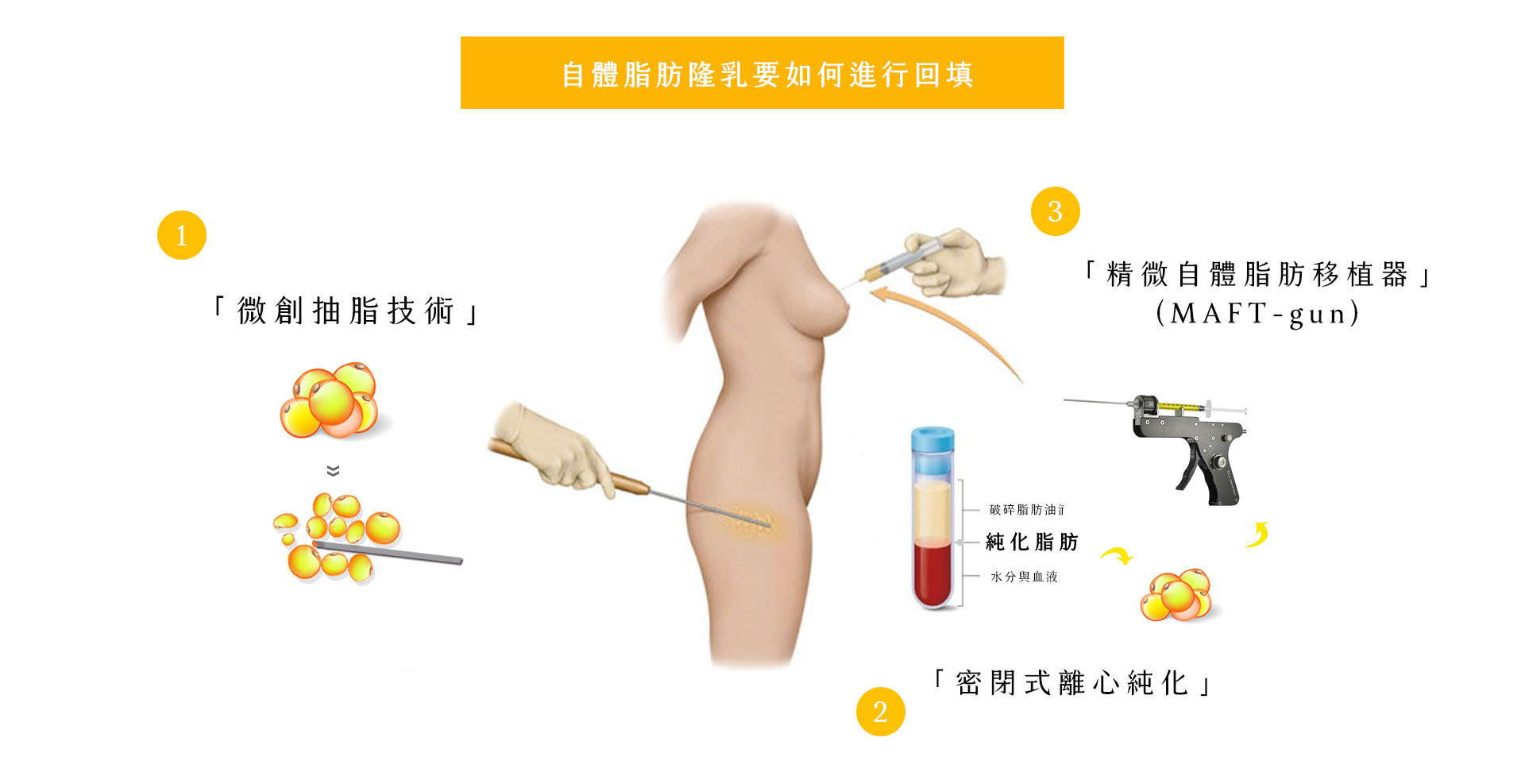 自體脂肪回填