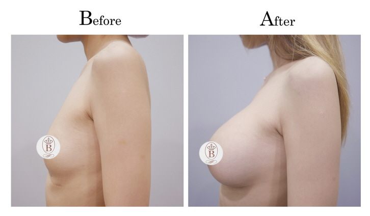 Sebbin柔滴隆乳術前術後比較圖片