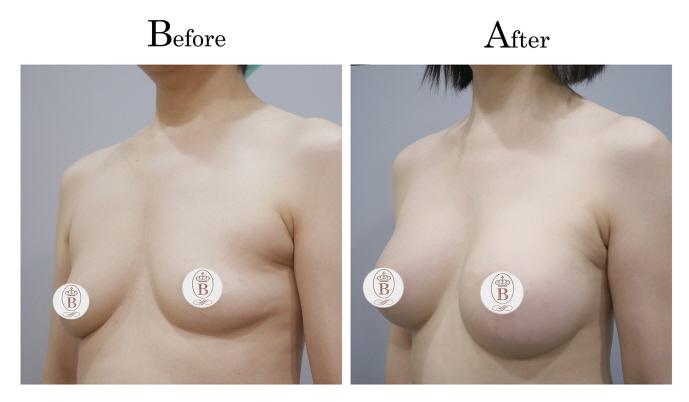 柔滴隆乳術前術後圖片對比