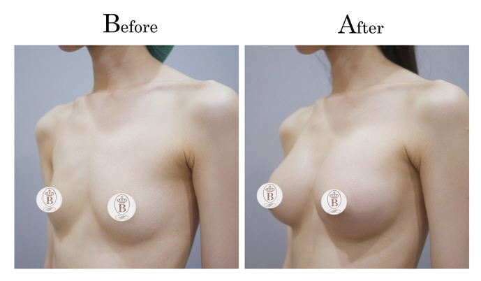 柔滴隆乳術前術後比較