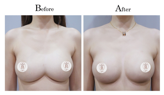 胸部太近連接分離-術前術後對比