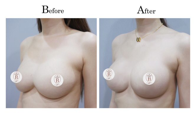 胸部太近連接分離-術前術後比較