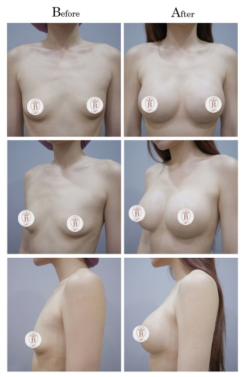 女王波隆乳術前術後比較圖