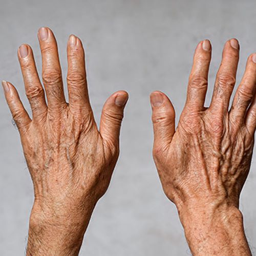 雞爪手改善療程|透過逆時針微整形注射改善雞爪手 台北教主醫美整形BishopClinic