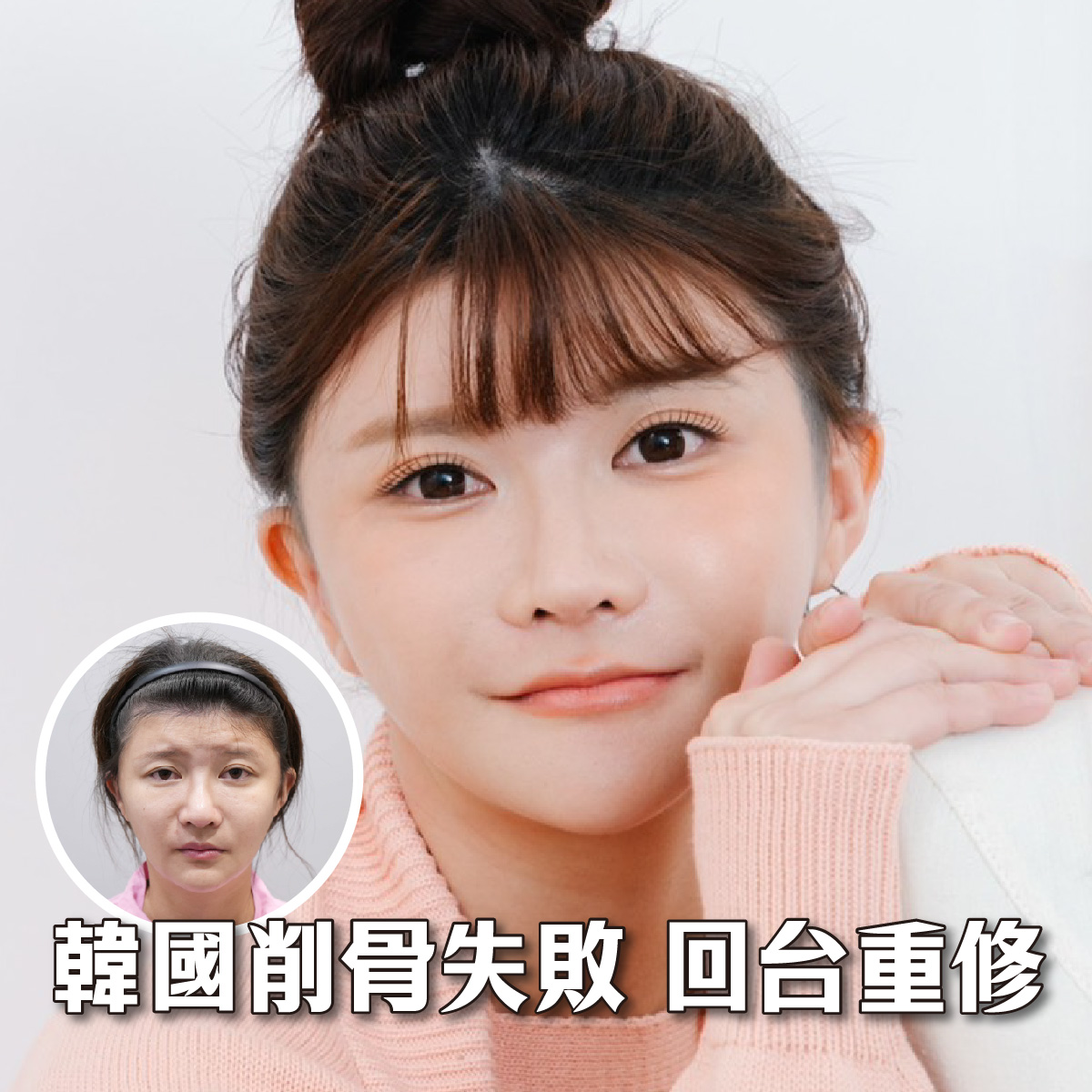 讓臉型比例與年輕感同時回歸的重修手術分享