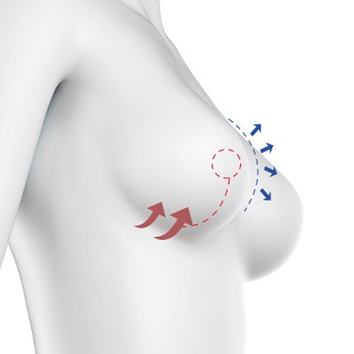 提乳手術完整解析｜胸部下垂怎麼辦？  提乳方式、費用、恢復期一次看懂 台北教主醫美整形外科診所 BishopClinic