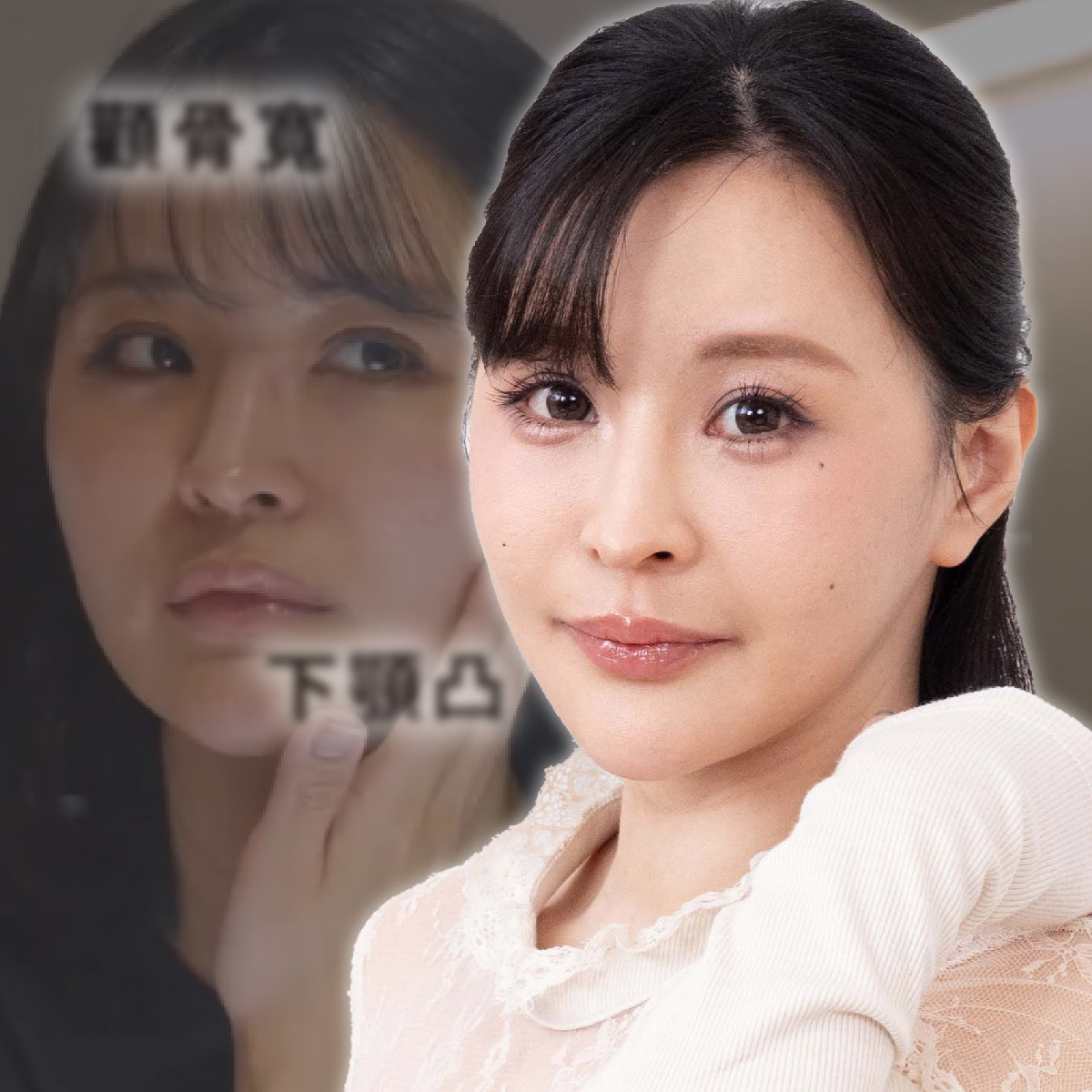 上下削骨+臉部取脂手術實例分享