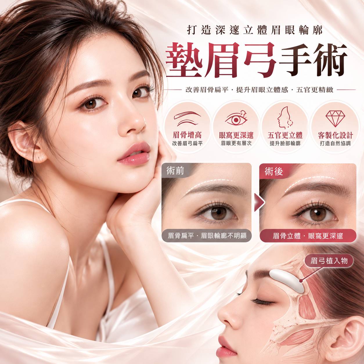 墊眉弓手術推薦｜眉骨增高、3D列印眉弓整形、材質費用與恢復期完整解析