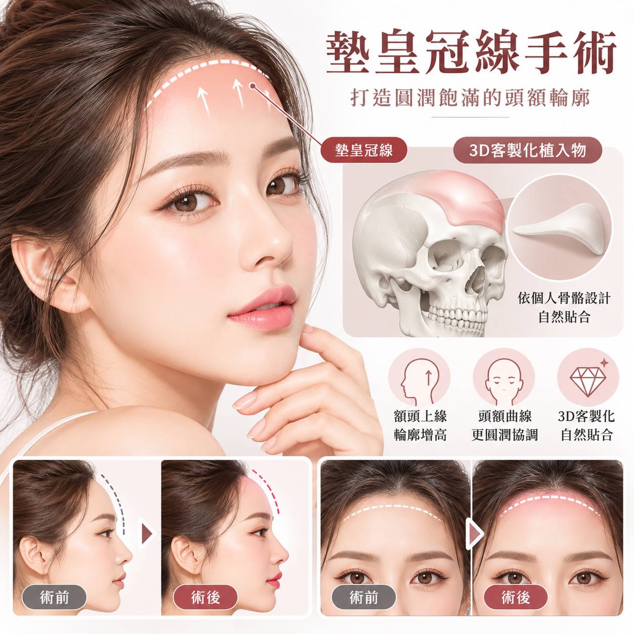 墊皇冠線手術推薦｜3D列印皇冠線整形、額頭輪廓增高、材質費用與恢復期完整解析