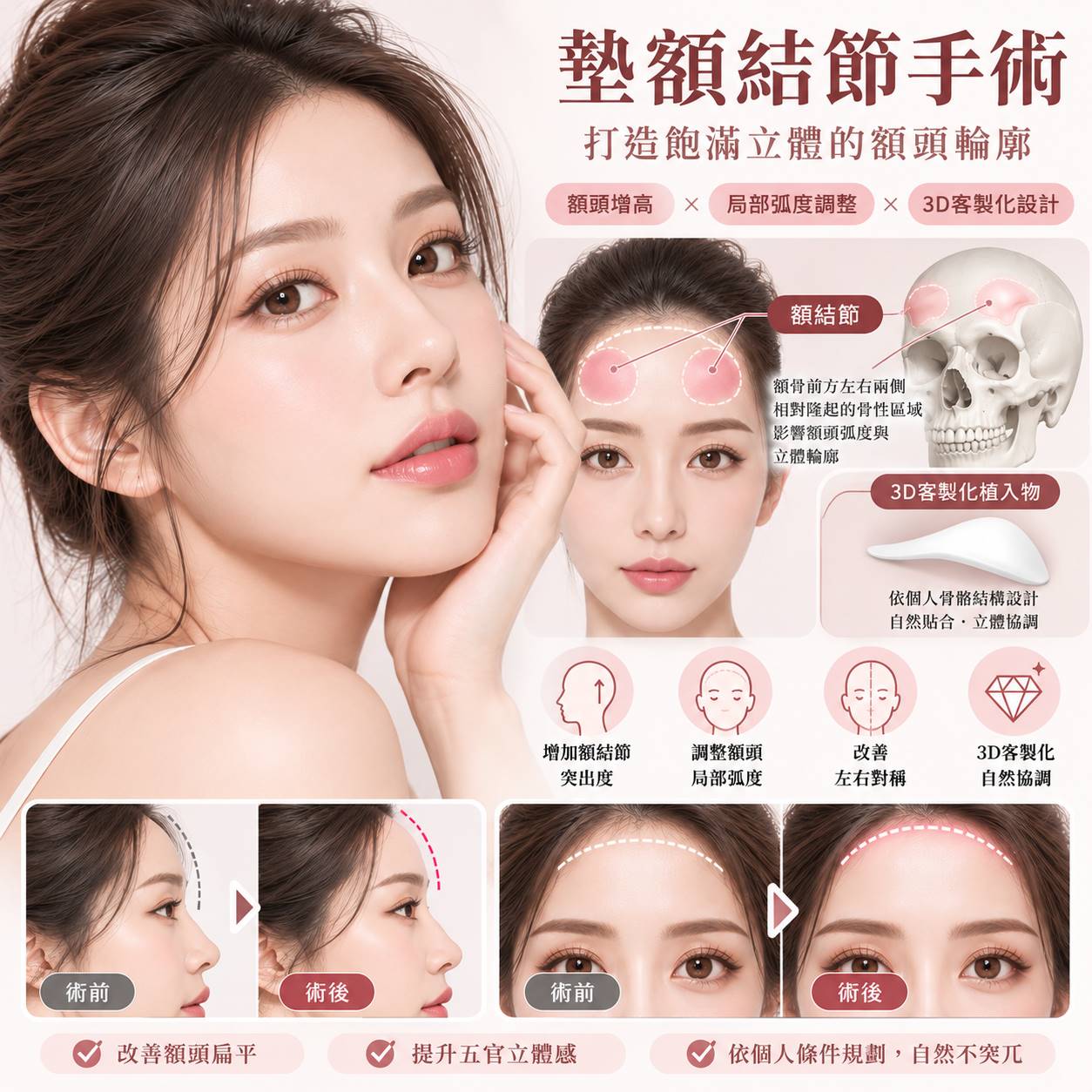 墊額結節手術推薦｜3D列印額結節整形、額頭增高、費用與恢復期完整解析